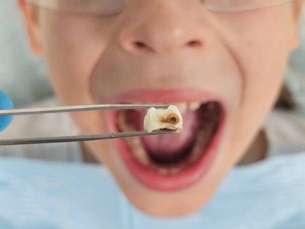 Best Emergency Broken Tooth Repair in Three Forks, MT